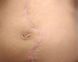 A stomach with a large curving scar running down it vertically