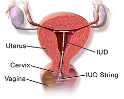 An illustration of a female reproductive system with an IUD in the uterus