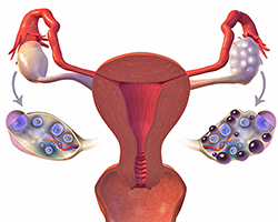 An illustration of the female reproductive system, with two ovaries. The ovary on the left is smooth, while the ovary on the right is bumpy and full of dark spots
