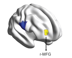 Right mid-frontal gyrus highlighted in yellow on this grey model of the brain