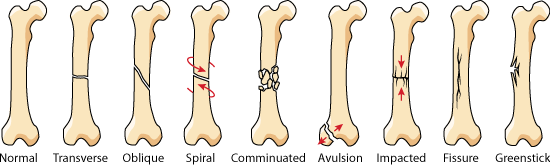 Fracture Types