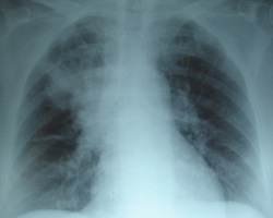 Lung xray in patient with pneumonia