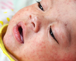 El rostro de un niño pequeño con una infección de sarampión.