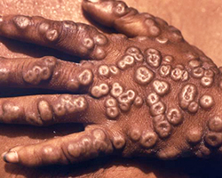 A hand covered in smallpox lesions