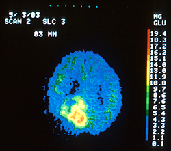 PET scan of a brain tumor.