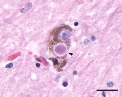 A Parkinson's Disease neuron with a Lewy Body in it.