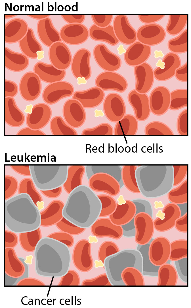 Two panels. The first shows normal blood with many healthy red blood cells. The second shows blood with leukemia, and shows a mixture of red blood cells and cancerous leukemia cells.