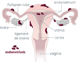 An illustration of the female reproductive system covered in dark red spots. 