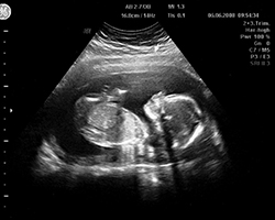 An ultrasound showing a fetus in the womb in black and white.