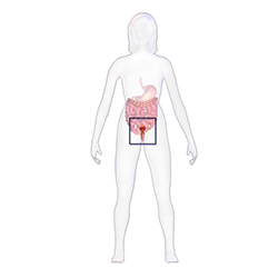 where in the body endometriosis occurs is highlighted within a colored box in a graphic of a female human body