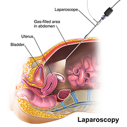An illustration of a laparoscopy