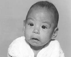 A black and white portrait of an infant with altered facial features due to FAS