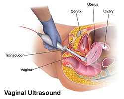 A diagram of a transducer inserted into a vagina to perform a vaginal ultrasound