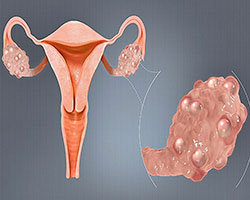 An illustration depicting the symptoms of PCOS. The image features a zoomed-out depiction of the whole female reproductive system, and a zoomed in look at an ovary covered in cysts.