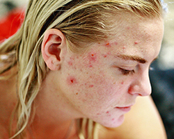 A close-up picture of a young blonde girl with red acne spots on the side of her face