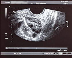 An ultrasound faintly shows an oval shape covered in dark spots