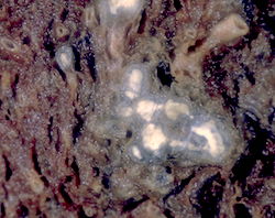 Tuberculosis in lungs