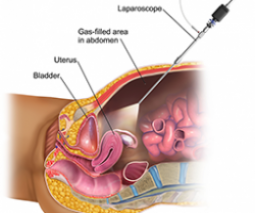 an illustration of a laporoscopy, showing a laporoscope entering a gas filled abdomen and illuminating the uterus