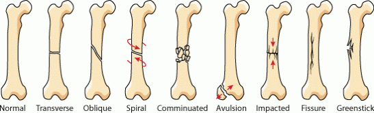bone fracture types