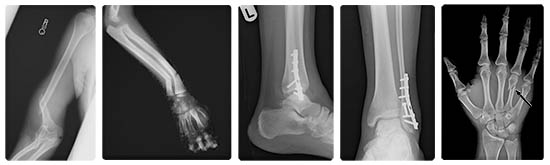 X-rays of broken bones