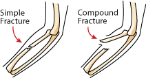 simple and compound fracture