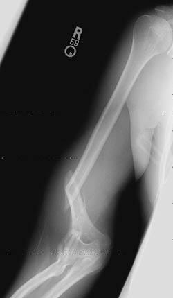 Broken arm bone - humerus