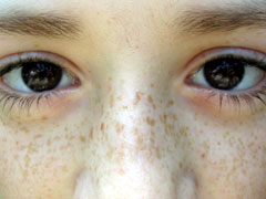 face freckles