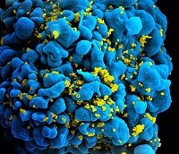 Infected HIV cell