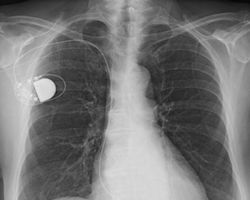 Pacemaker x-ray