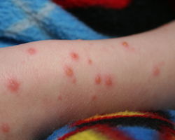 A child's arm with chicken pox