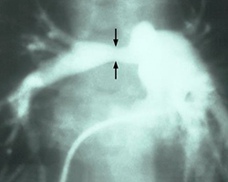 An image of a child's heart showing a restricted artery due to congenital rubella.