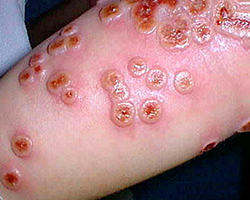 An infection of cowpox on a child's arm