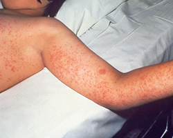 The rash of a child with measles, showing the inside of the arm and the upper torso.