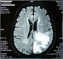An MRI scan that shows a brain tumor. 