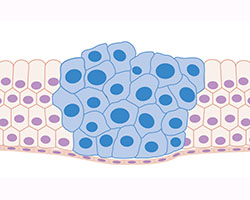 Cancer cell cartoon