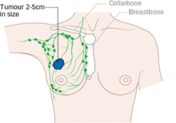 a cartoon image of a woman's breasts. The skin is light tan, and shows a tumor on the right breast in blue. The lymph nodes around the area are shown in green, and the breastbone in white in the middle of the chest.