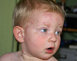 A blond-headed child that has chicken pox