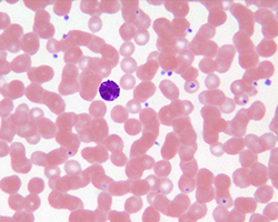 An image of blood through a microscope showing pink red blood cells and one purple-stained immune cell, a basophil
