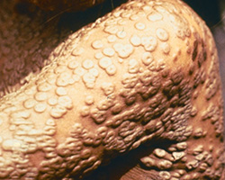smallpox arm