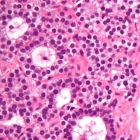 Cancer cells from the parathyroid gland