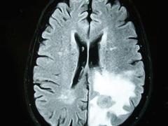 An MRI image of a brain tumor