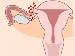 An illustration of a female reproductive system with a ruptured fallopian tube with red blood drops coming out of it