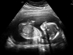 An ultrasound showing a blurry image of a fetus.