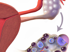 An image of ovaries in a person with PCOS. The image features an external look at a bumpy ovary attached to the rest of the female reproductive system, as well as a close-up, detailed look at the cysts within the ovary.