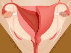 Illustrated image of a uterus, ovaries, and fallopian tubes