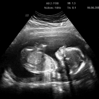 An ultrasound showing a blurry image of a fetus.