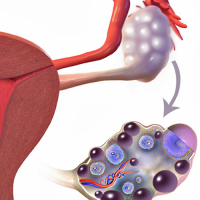 An image of ovaries in a person with PCOS. The image features an external look at a bumpy ovary attached to the rest of the female reproductive system, as well as a close-up, detailed look at the cysts within the ovary.