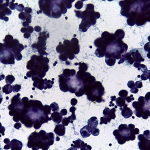 breast cancer cells stained purple