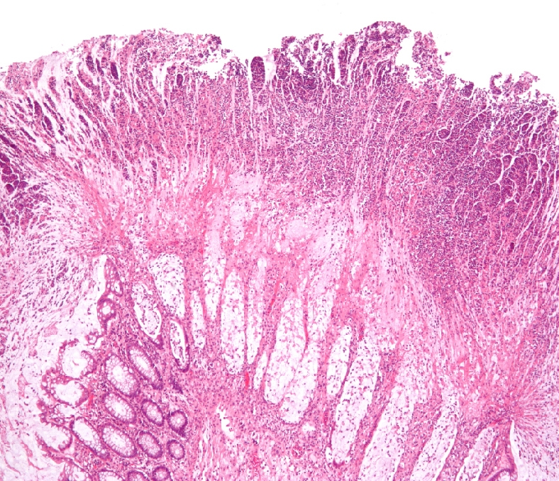 Intestinal tissue under attack by a C. diff infection