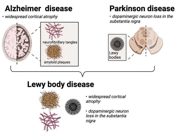 Comparison between Alsheimer's, Parkinson's, and Lewy boy diseases.